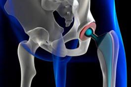 Limpieza de dispositivos medicos